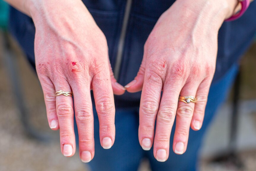 Two hands with dermatitis appearing over the knuckles.