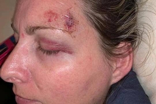 Amanda Treagus with a bruised eye and injury to her head
