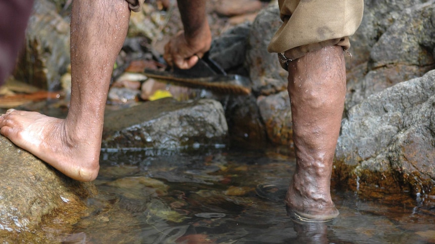 Varicose veins on the leg of a railway worker in India.