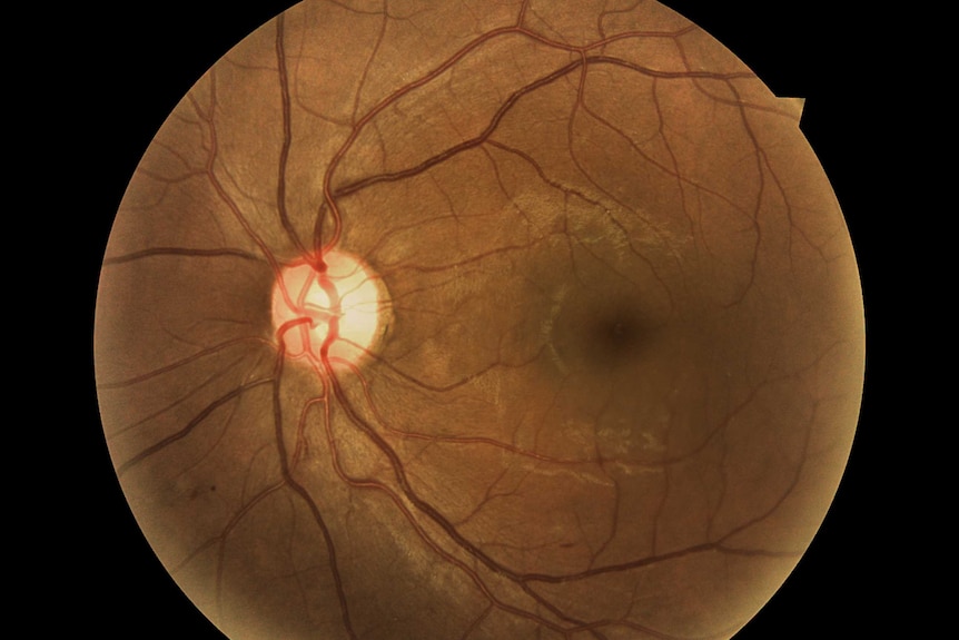 Remote-I retina scan CSIRO