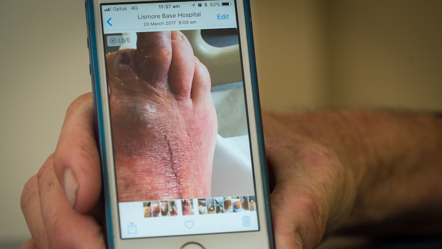 A photo of a foot with amputated toes displayed on a mobile phone held in a man's hand