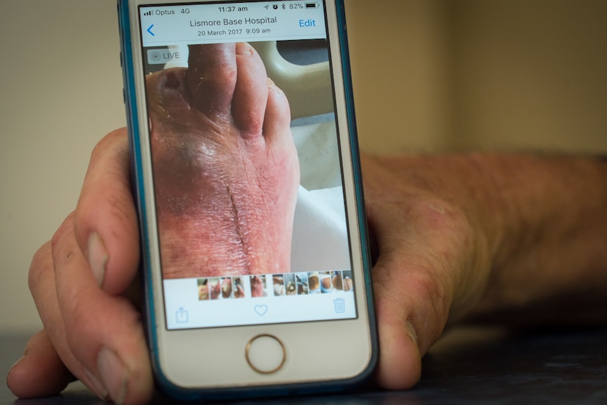 A photo of a foot with amputated toes displayed on a mobile phone held in a man's hand