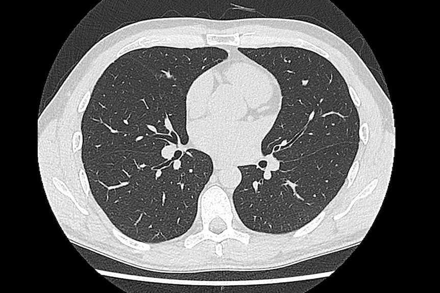 A CT scan showing healthy lungs.
