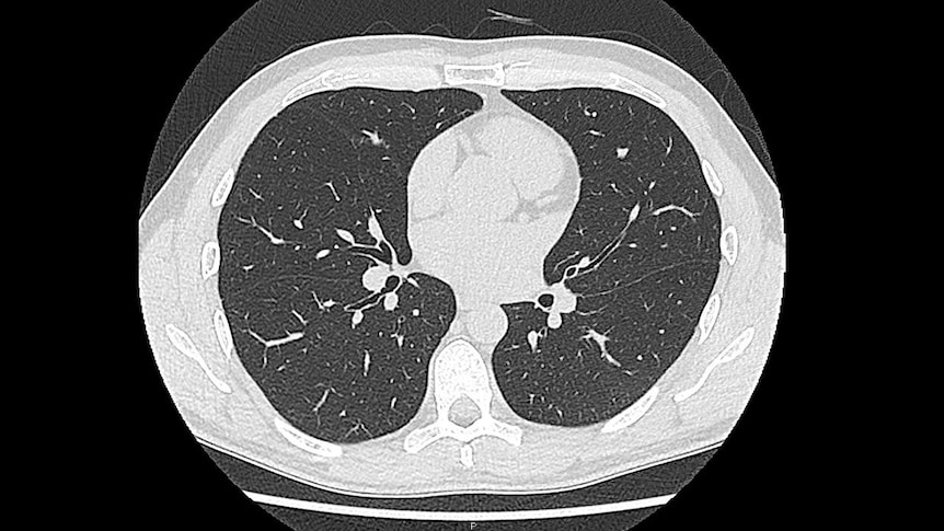 A CT scan showing healthy lungs.