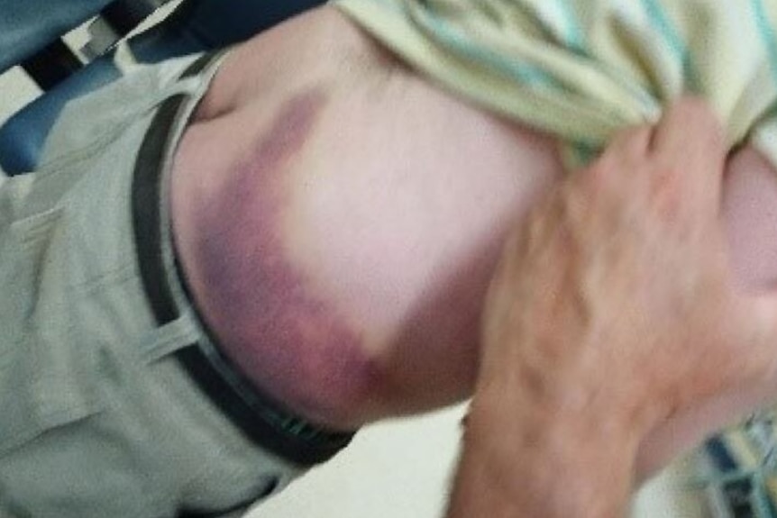 A large purple bruise on the bottom half of a man in a green t-shirt.