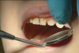 Video still: Close up of child's teeth being examined by dentist Aug 2012
