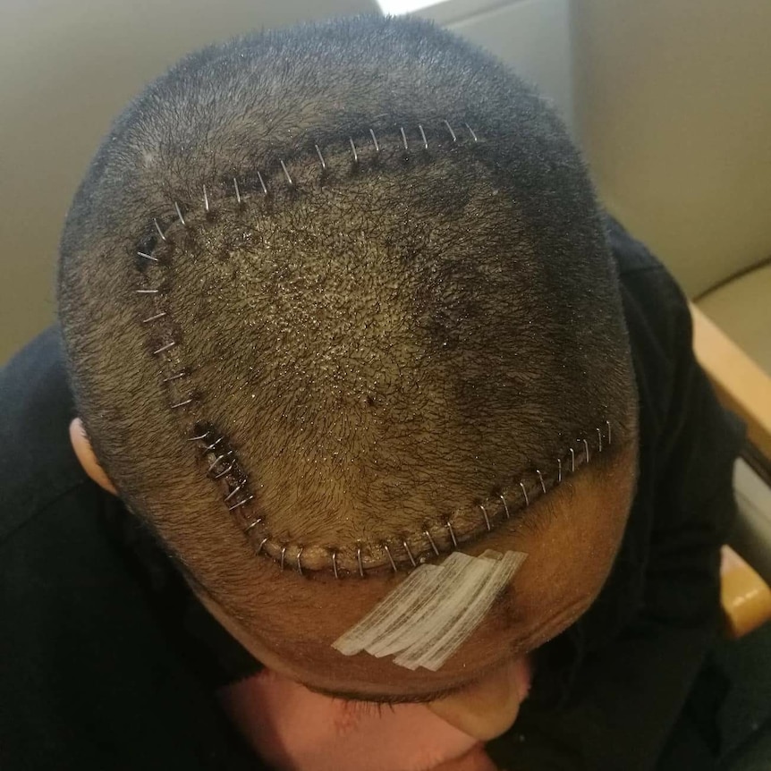 The top of Ms Haro's  head showing the number of staples she had after surgery.
