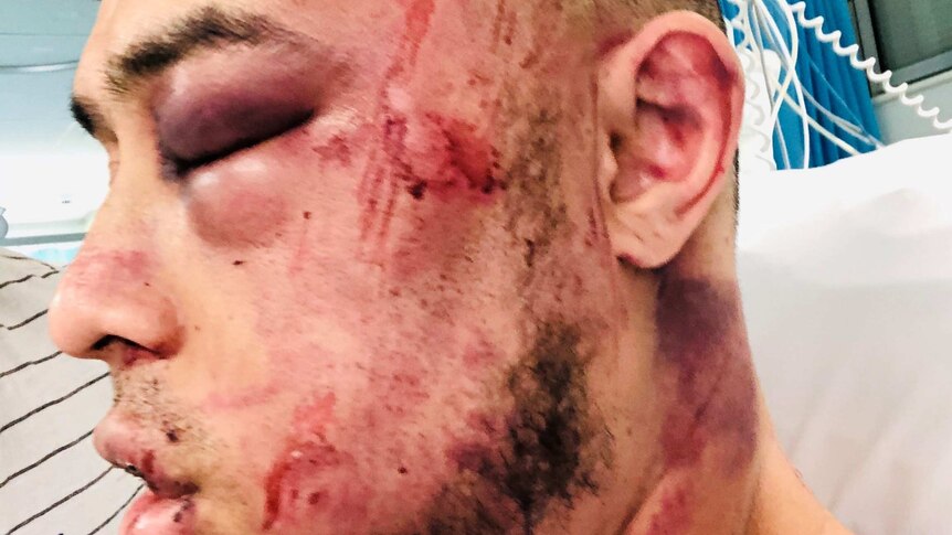 Close-up of a man siting on a hospital bed with extensive bruises over his face and staples across his skull.