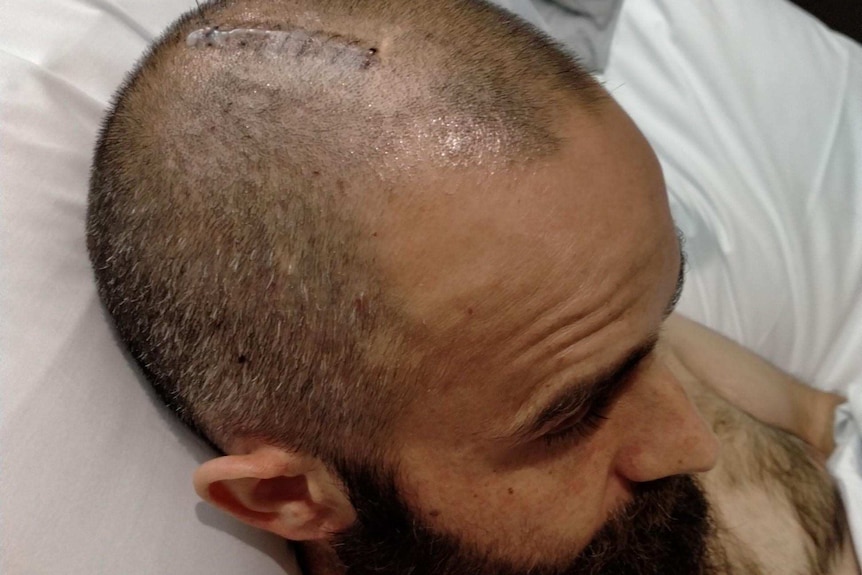 A close up image of a man in hospital bed showing scar on head
