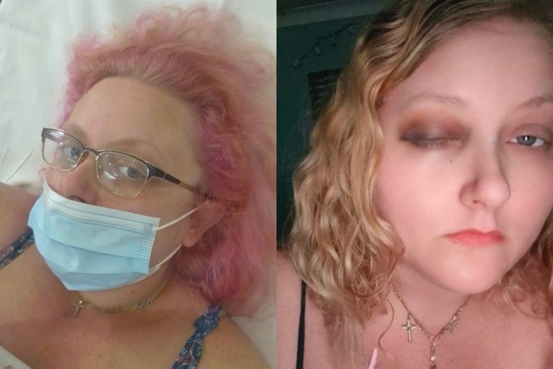 Lady in face mask in hospital and lady with black/bruised eye