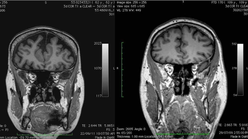 A scan of Christine Bryden's brain (L) compared to a normal brain.