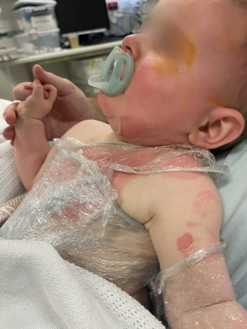 A baby with burns in a hospital bed.