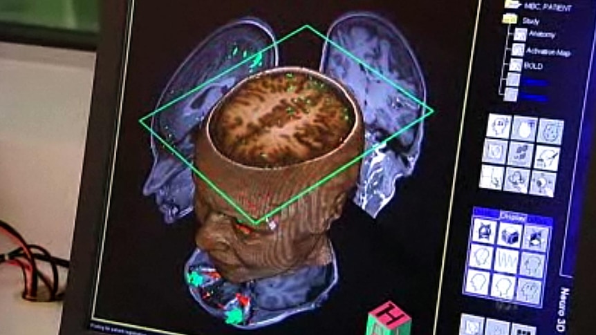 A brain is scanned at Melbourne's Florey Neuroscience Institute.