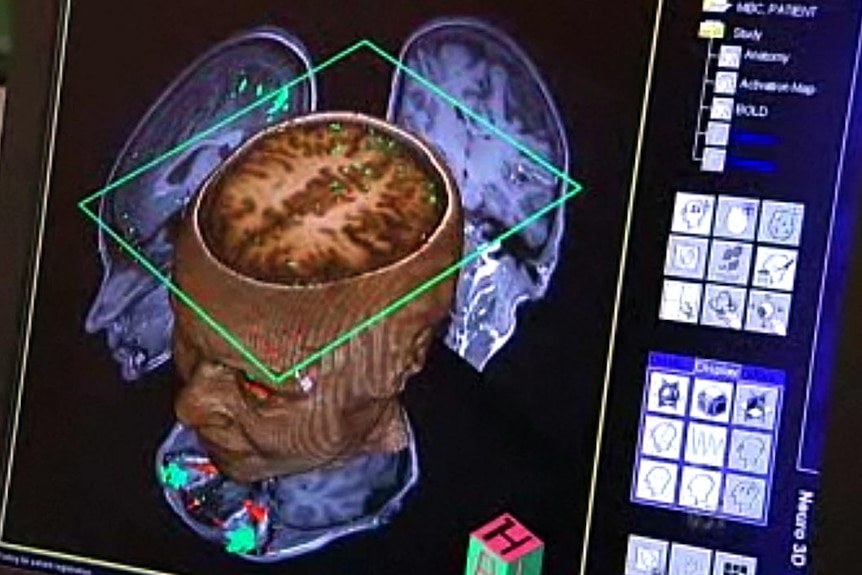 A brain is scanned at Melbourne's Florey Neuroscience Institute.