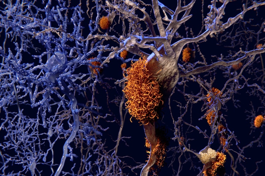 Computer illustration of brain nerve cells affected by Alzheimer's disease.