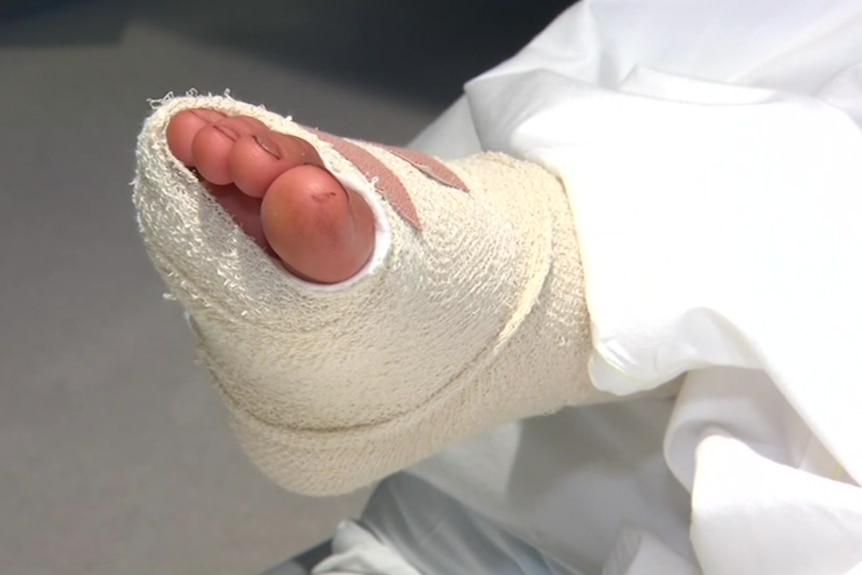 A close up photo of Jackson Bartlett's bandaged foot.