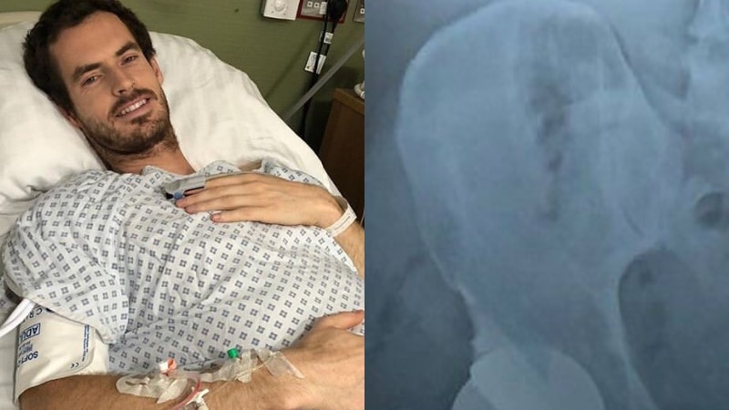 a photo of Andy Murray recovering in hospital next to an x-ray of his hip