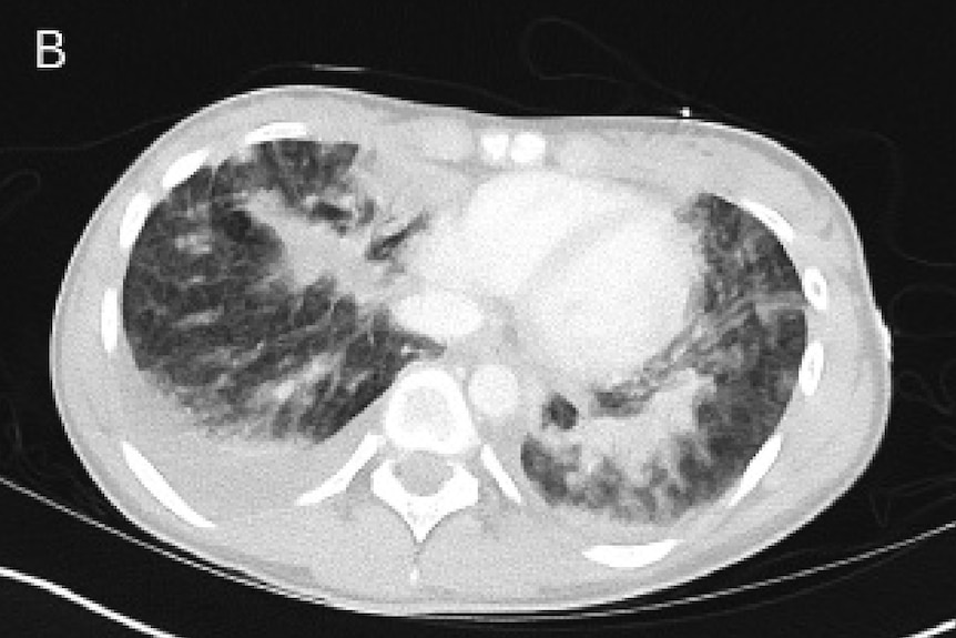 An X-ray cross section of Dakota Stephenson's lungs.