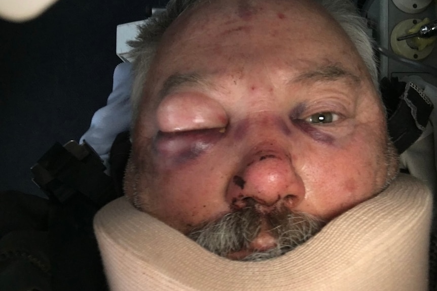A close up photo of Jim with one eye swollen shut, a cut on his nose, eye bruising and wearing a neckbrace.