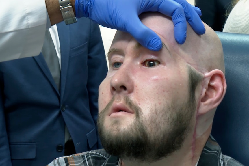 A transplanted eye is examined by a doctor wearing a blue glove.
