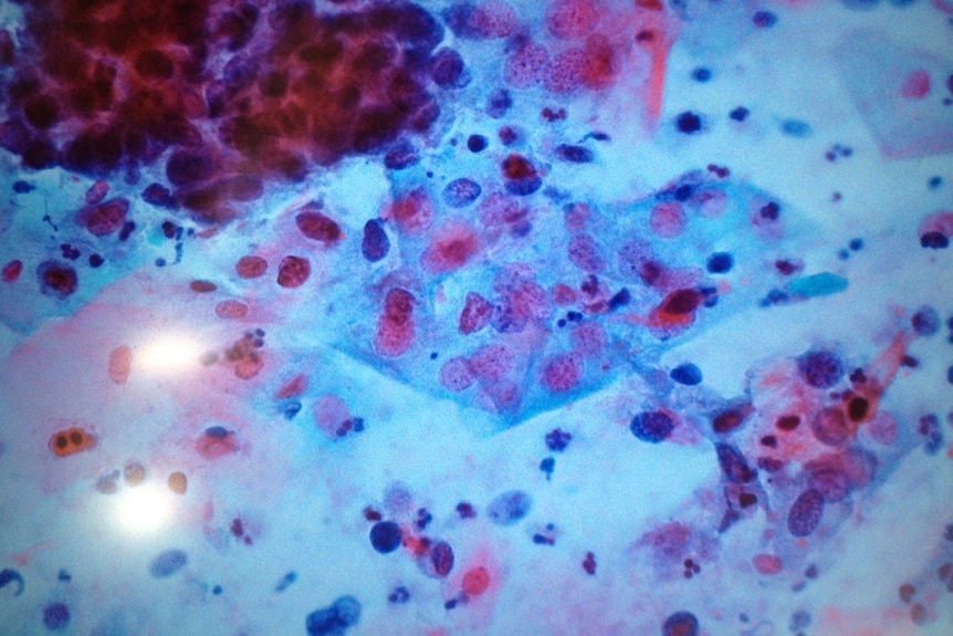 Abnormal cells in cervical screening test