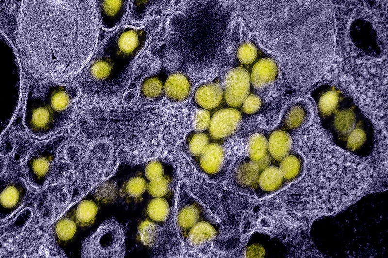 Colour-enhanced transmission electron micrograph of SARS-CoV-2 virus particles, isolated from a patient.
