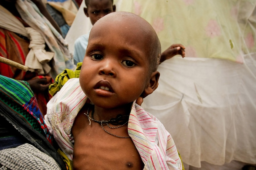 A woman holds a severely malnourished child in a refugee camp in Mogadishu, Somalia.