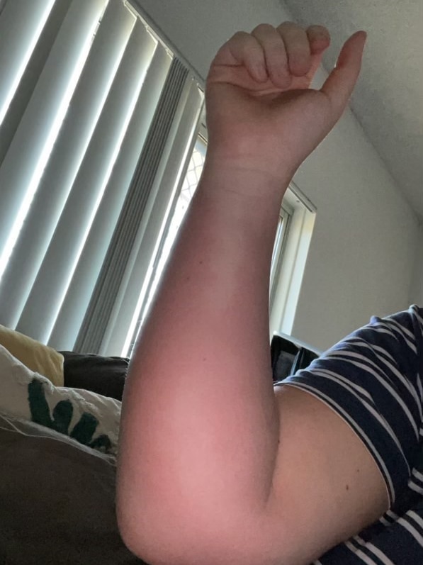 Swollen arm from March fly bite.