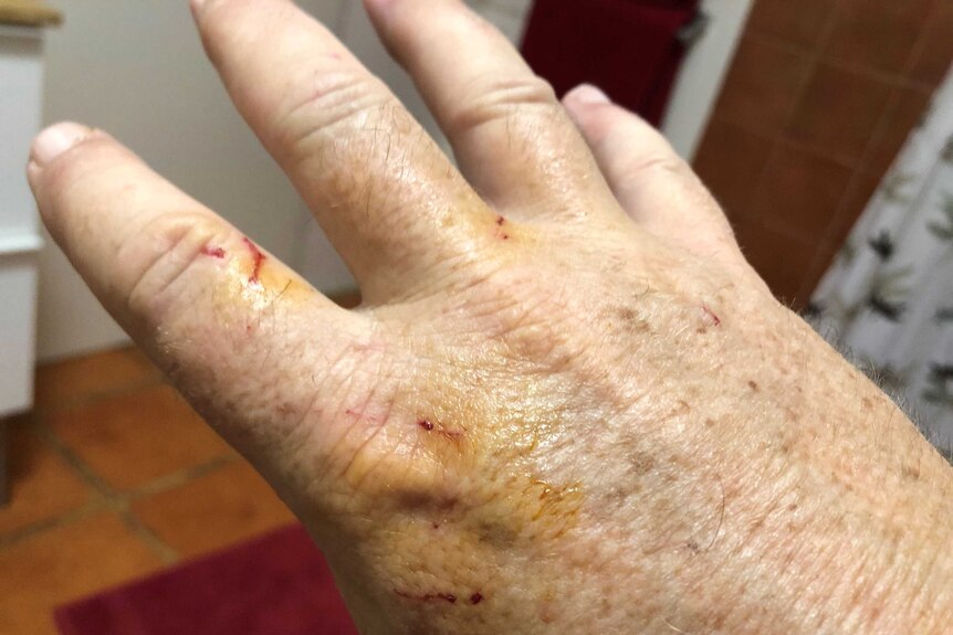 Close up of right hand with minor snake bites.