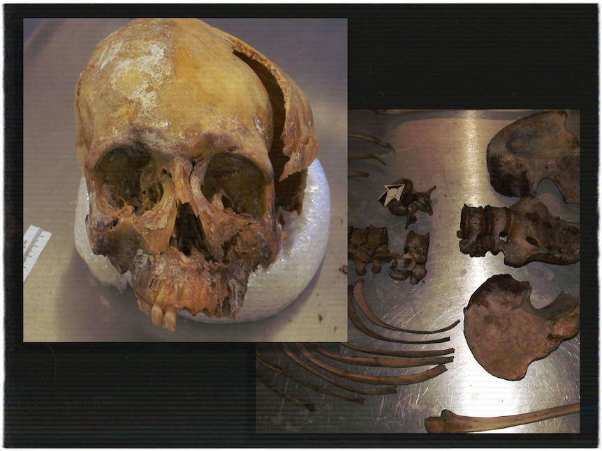 Two composited images, one of a broken skull, the other of various bones including a spine and ribs on a metal table.