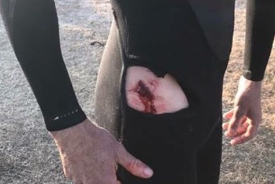 Gash seen on surfer's leg