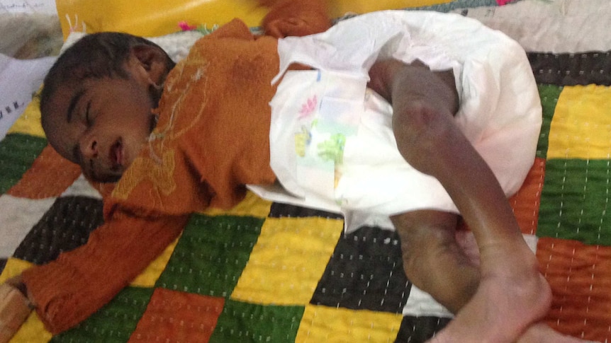 Malnourished baby in Pakistani hospital