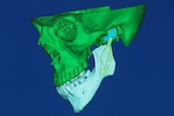 3D scan of printed jaw