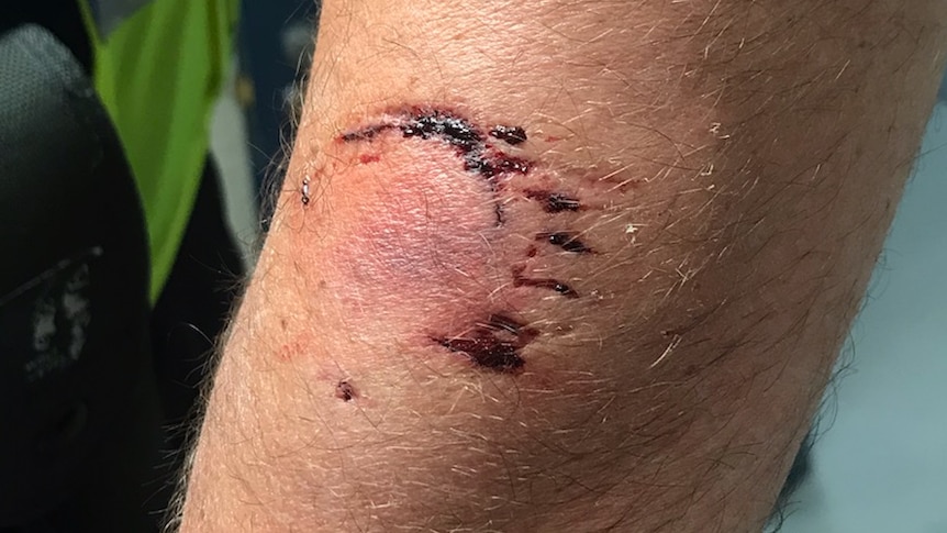 A human bite mark is scabby and inflamed on a man's arm. His police uniform is visible