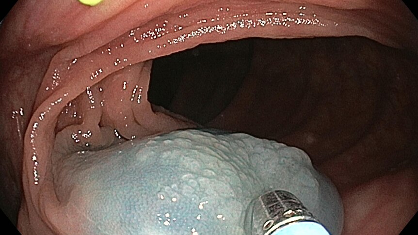 Image of a colon polyp.