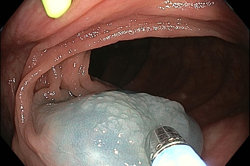 Image of a colon polyp.