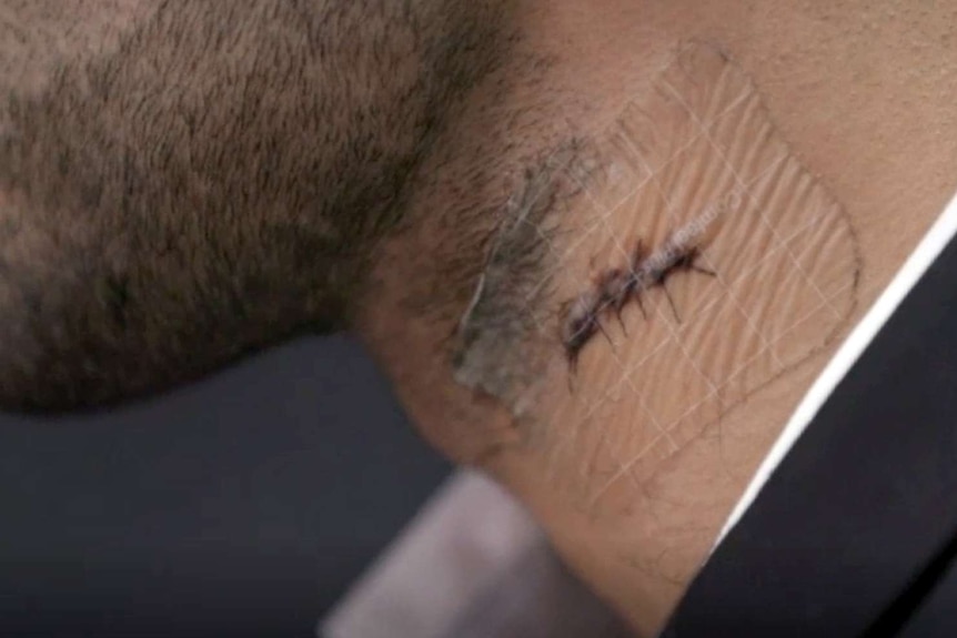 A close up of a man's neck with a wound with several stiches covered in a clear bandage.