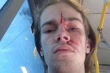 Photo of Sean after attack in Bulimba