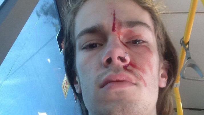 Photo of Sean after attack in Bulimba