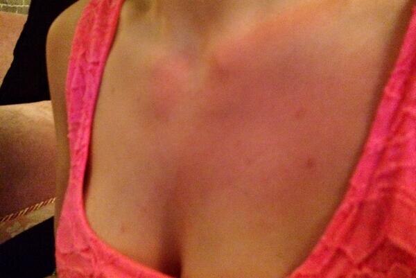 Bruises on Maria Alyokhina twitter