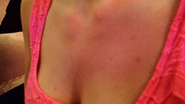 Bruises on Maria Alyokhina twitter
