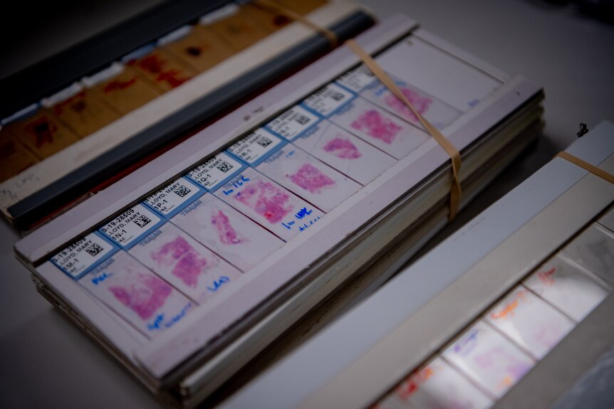 Microscope slides containing tissue taken from ABC journalist Mary Lloyd.