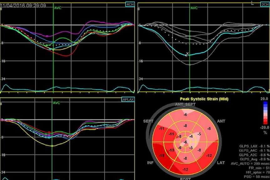 A black screen with graphs showing strain on the hearts of cardiac patients