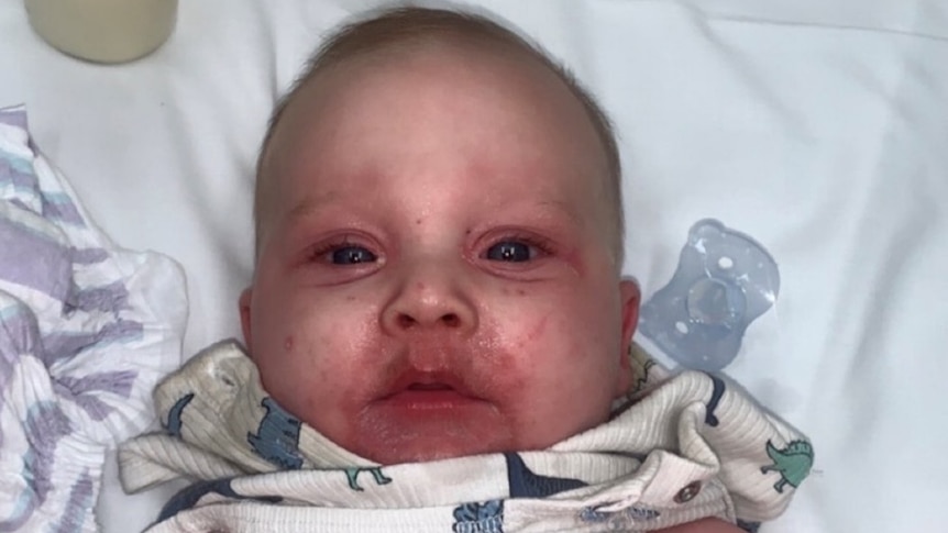 Jarrod after being moved to a bed in the emergency department at Caboolture Hospital, red rash around mouth and cheeks