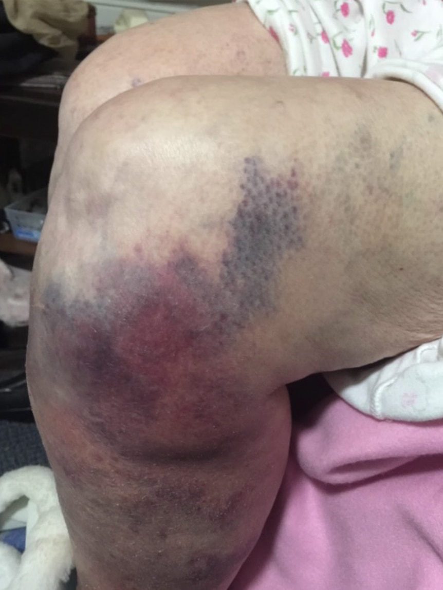 A bad bruise on an elderly woman's leg after a fall