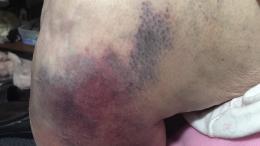 A bad bruise on an elderly woman's leg after a fall