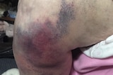 A bad bruise on an elderly woman's leg after a fall