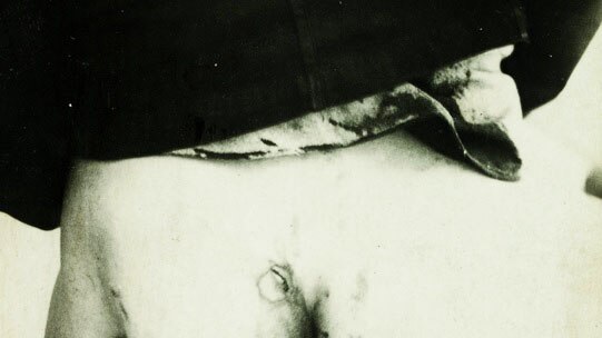 Wounds suffered by a WWI camp prisoner