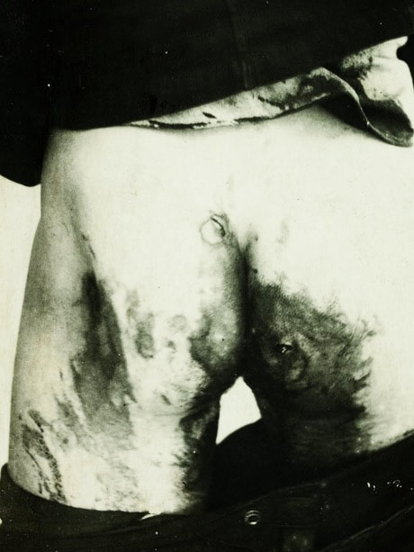 Wounds suffered by a WWI camp prisoner
