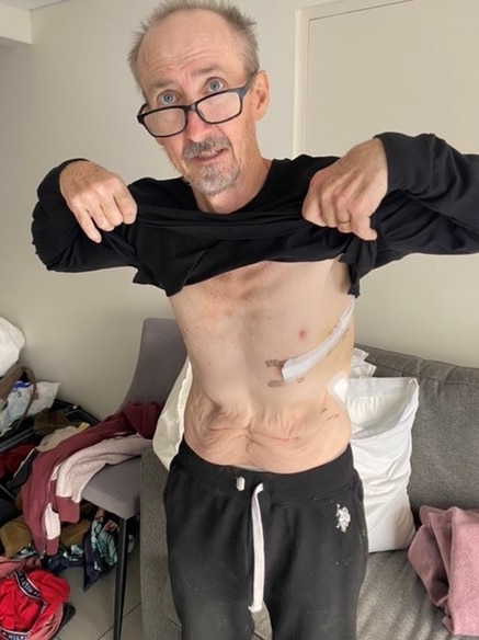 Stephen holds his shirt up, showing the scars from his surgeries.